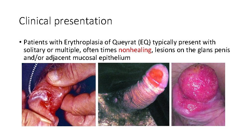 Clinical presentation • Patients with Erythroplasia of Queyrat (EQ) typically present with solitary or