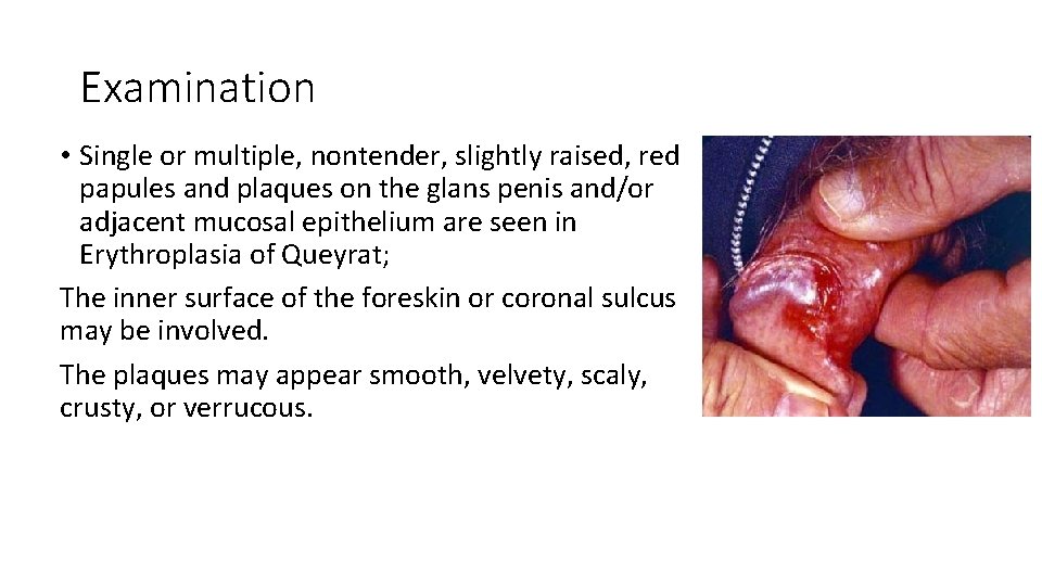 Examination • Single or multiple, nontender, slightly raised, red papules and plaques on the