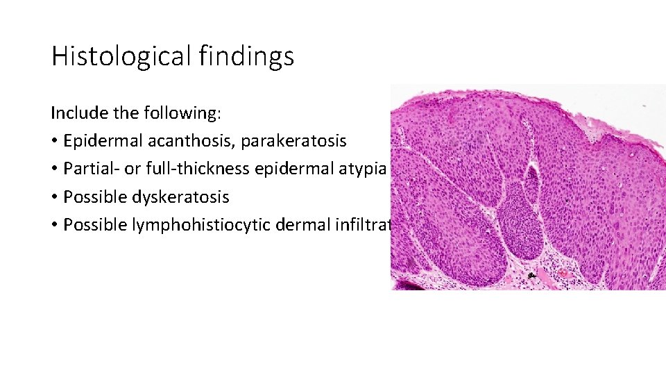 Histological findings Include the following: • Epidermal acanthosis, parakeratosis • Partial- or full-thickness epidermal