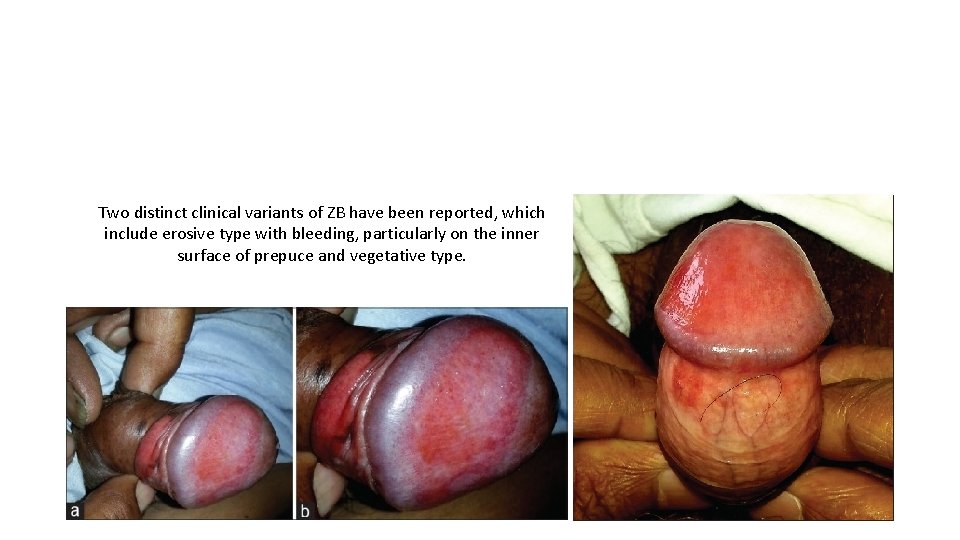 Two distinct clinical variants of ZB have been reported, which include erosive type with