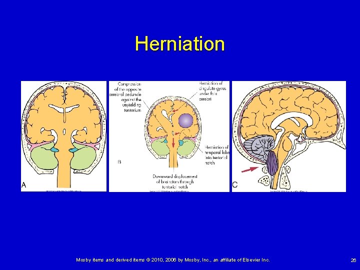 Herniation Mosby items and derived items © 2010, 2006 by Mosby, Inc. , an