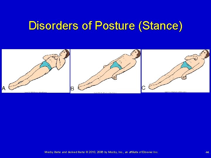 Disorders of Posture (Stance) Mosby items and derived items © 2010, 2006 by Mosby,