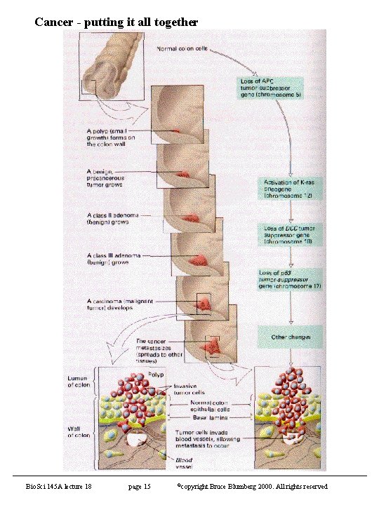 Cancer - putting it all together Bio. Sci 145 A lecture 18 page 15