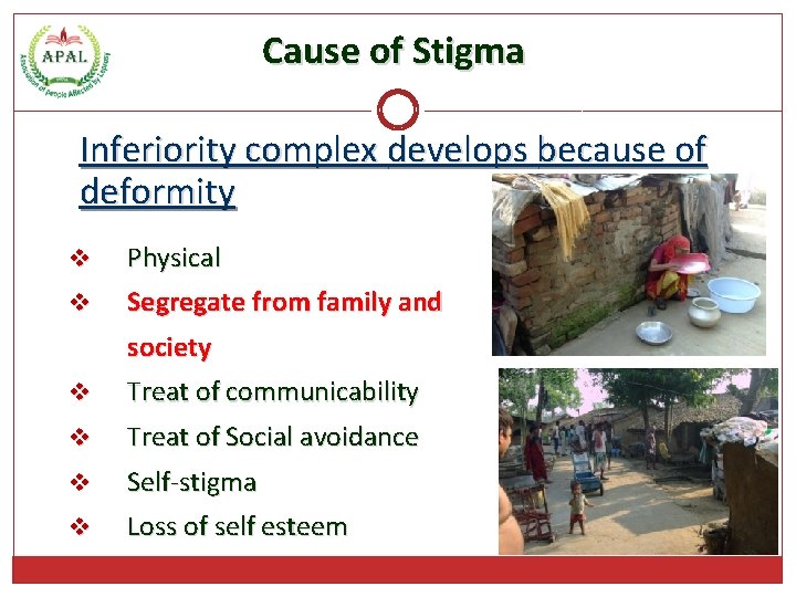 Cause of Stigma Inferiority complex develops because of deformity v Physical v Segregate from