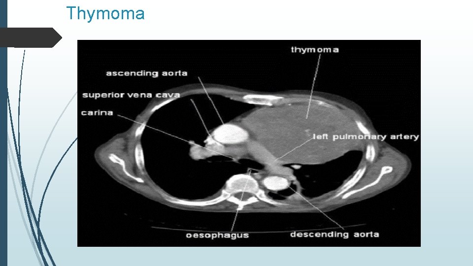 Thymoma 