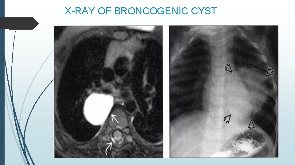 X-RAY OF BRONCOGENIC CYST 