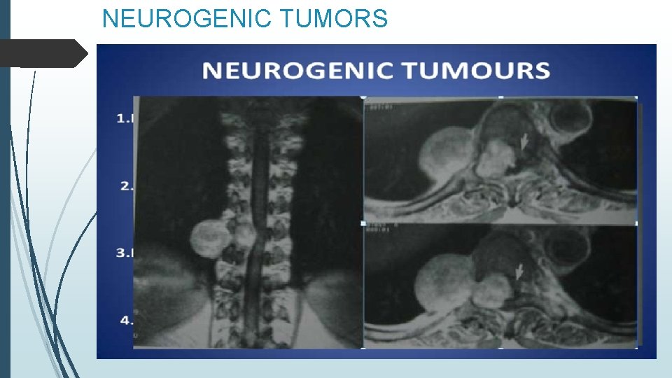 NEUROGENIC TUMORS 