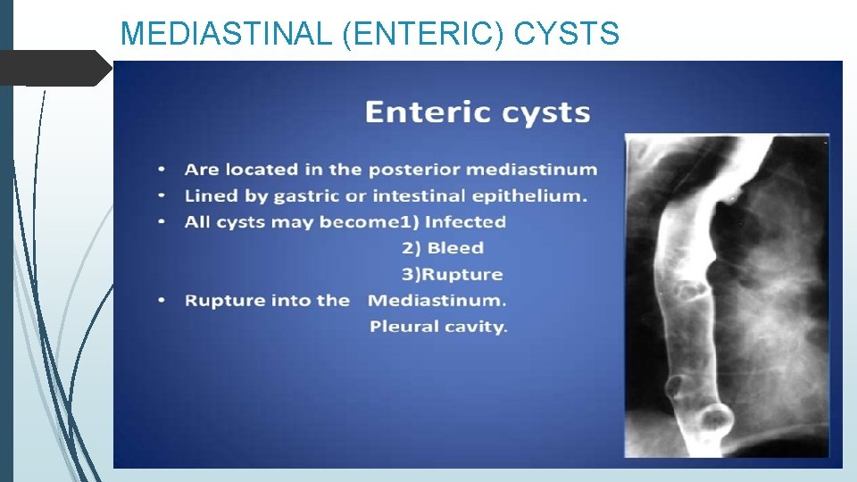 MEDIASTINAL (ENTERIC) CYSTS 