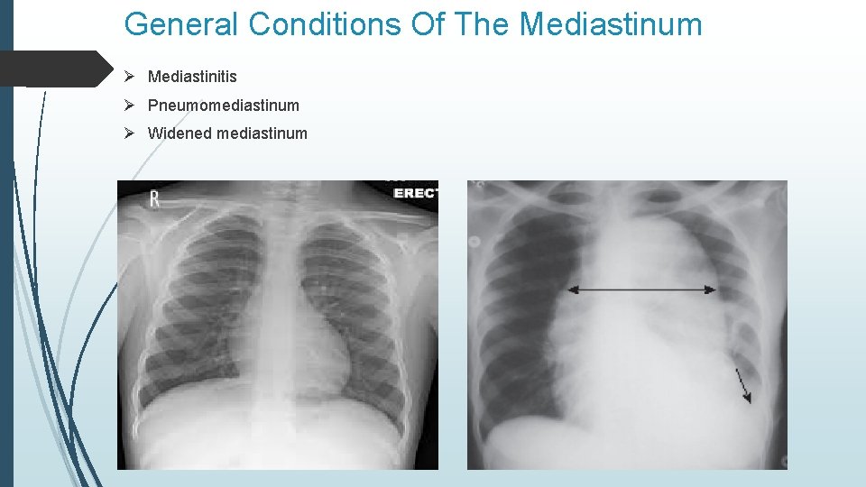 General Conditions Of The Mediastinum Ø Mediastinitis Ø Pneumomediastinum Ø Widened mediastinum 