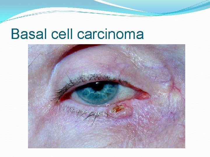 Basal cell carcinoma 