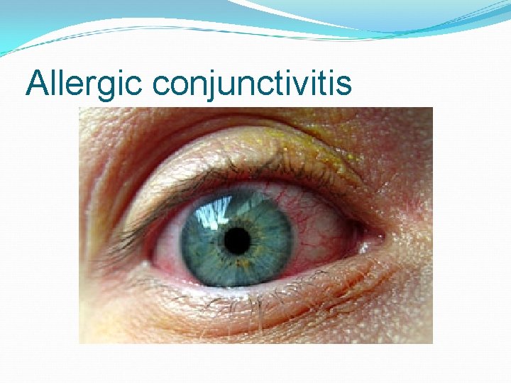 Allergic conjunctivitis 