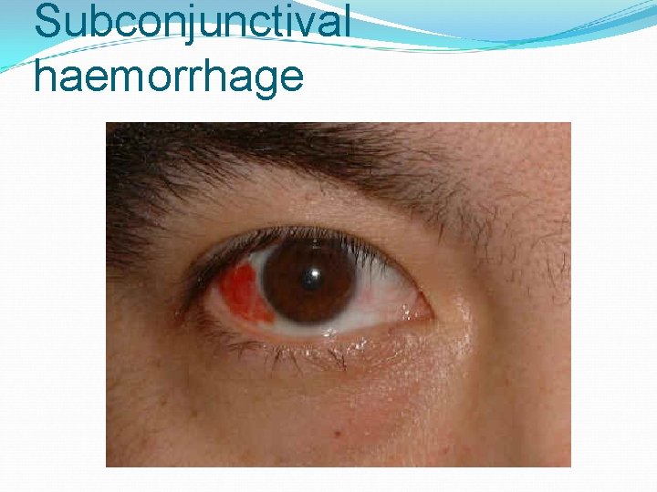 Subconjunctival haemorrhage 