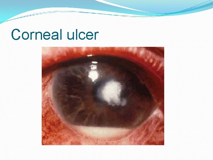 Corneal ulcer 