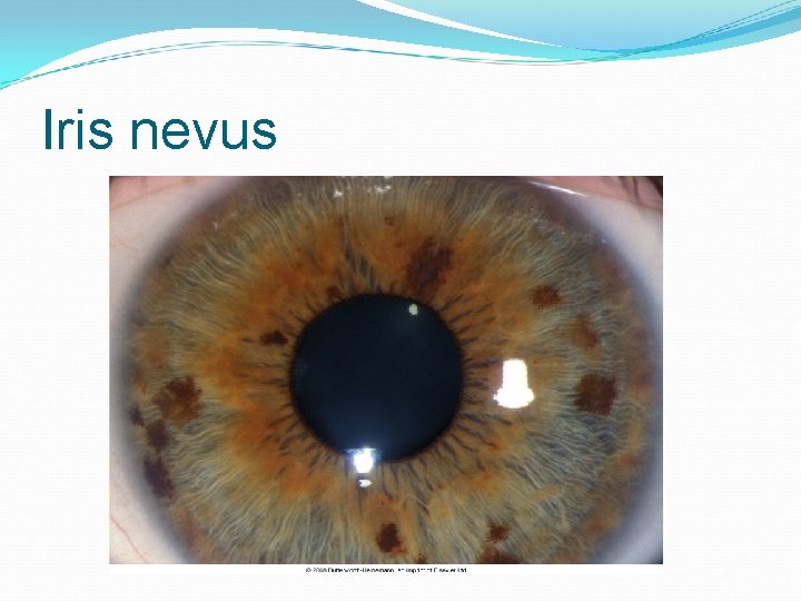 Iris nevus 