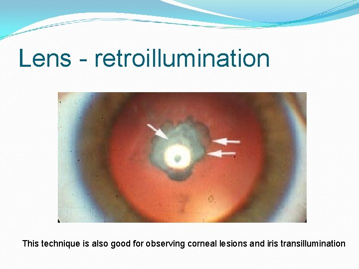 Lens - retroillumination This technique is also good for observing corneal lesions and iris
