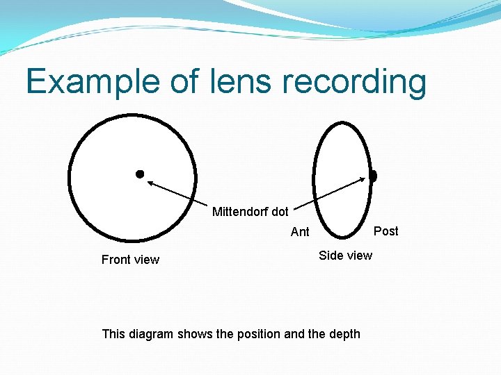 Example of lens recording Mittendorf dot Post Ant Front view Side view This diagram