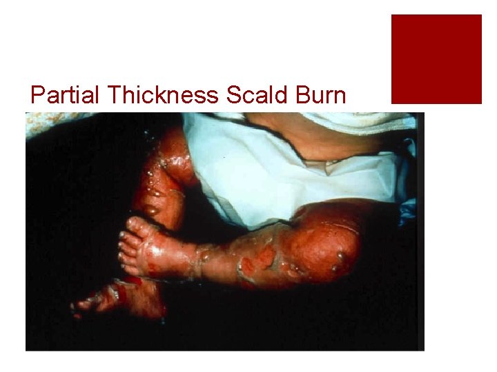 Partial Thickness Scald Burn 