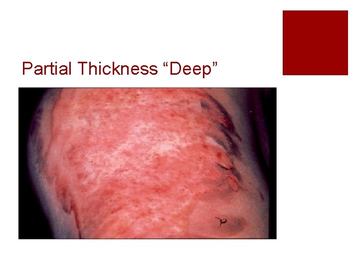 Partial Thickness “Deep” 