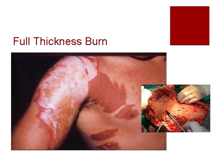 Full Thickness Burn 