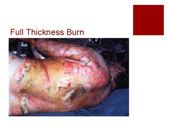 Full Thickness Burn 