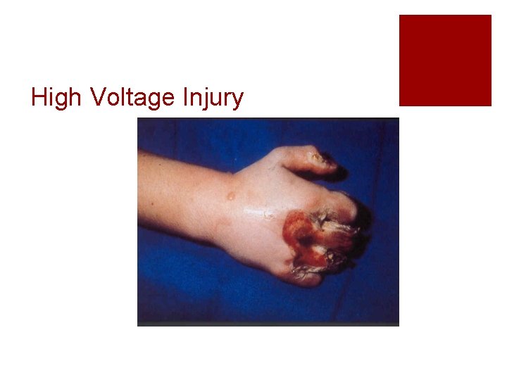 High Voltage Injury 