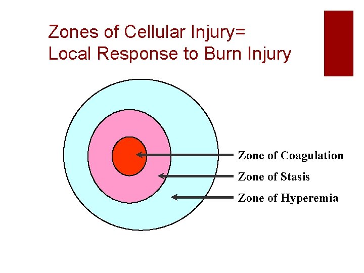 Zones of Cellular Injury= Local Response to Burn Injury Zone of Coagulation Zone of