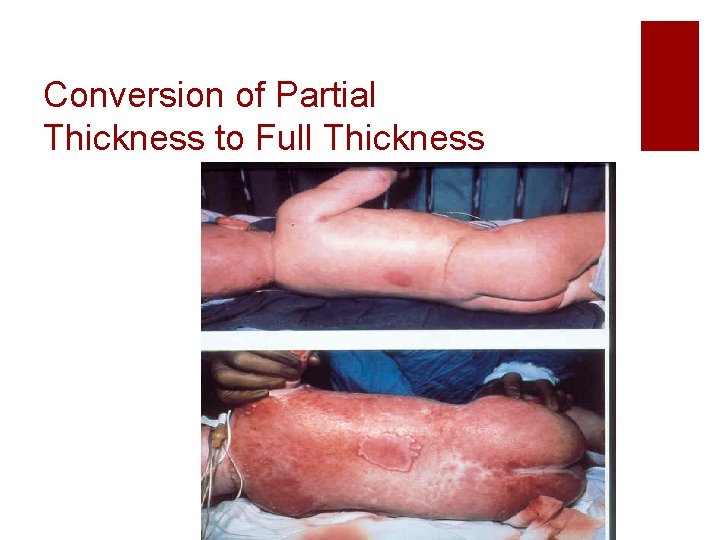 Conversion of Partial Thickness to Full Thickness 
