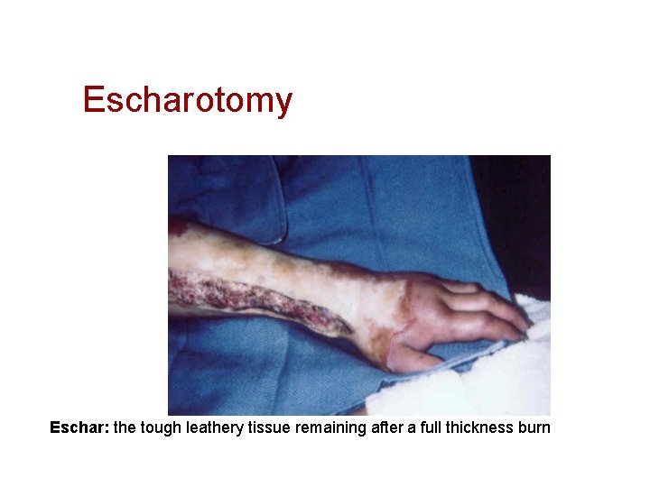 Escharotomy Eschar: the tough leathery tissue remaining after a full thickness burn 