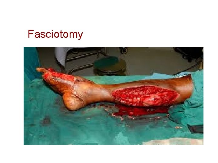 Fasciotomy 