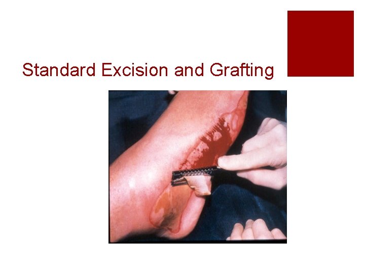 Standard Excision and Grafting 