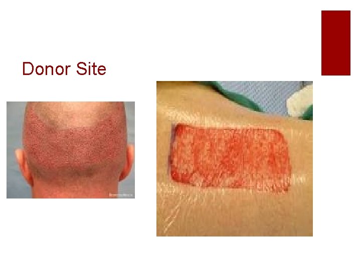 Donor Site 