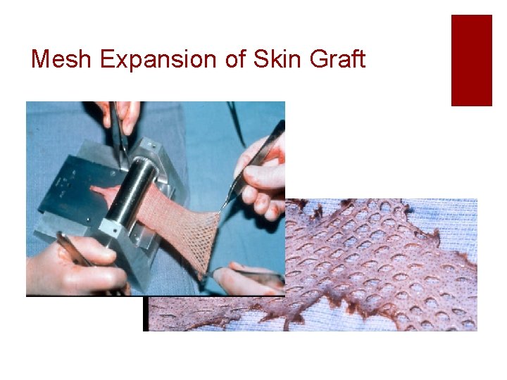 Mesh Expansion of Skin Graft 