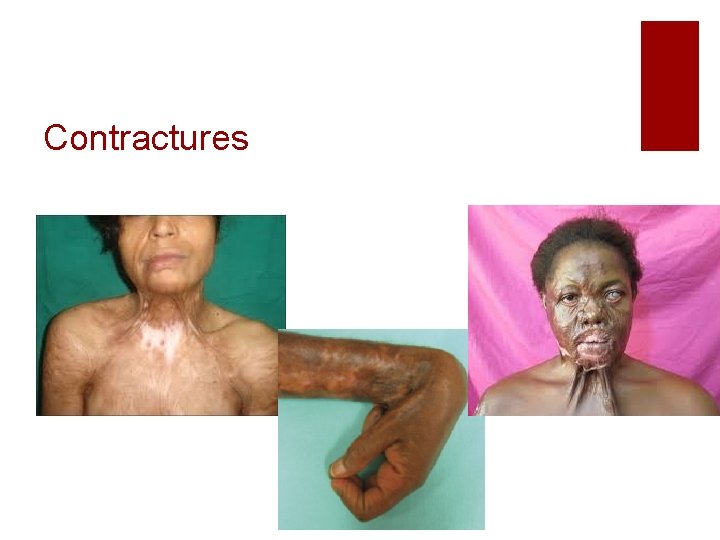 Contractures 
