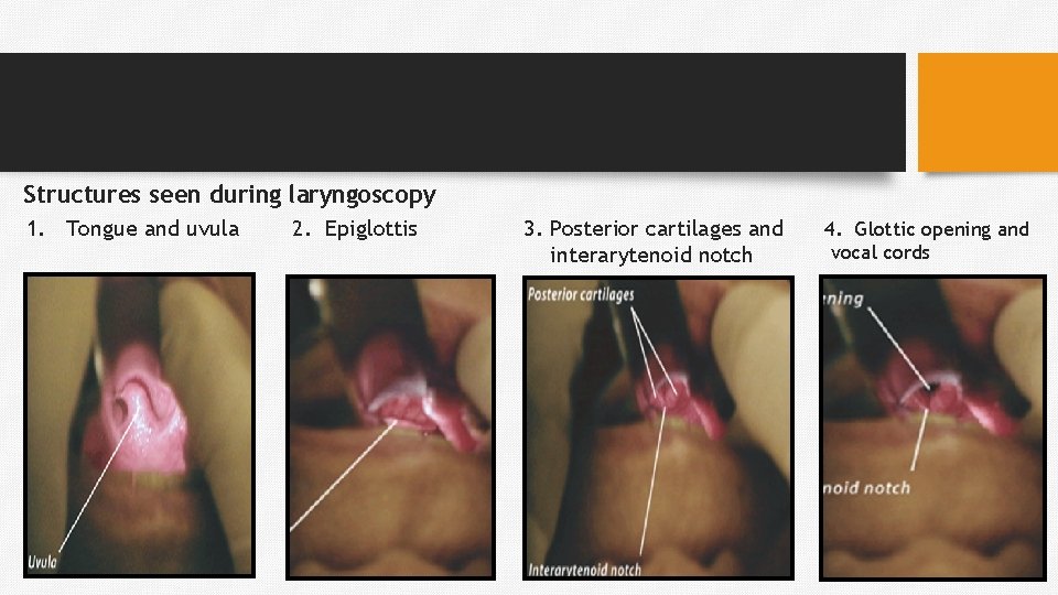 Structures seen during laryngoscopy 1. Tongue and uvula 2. Epiglottis 3. Posterior cartilages and
