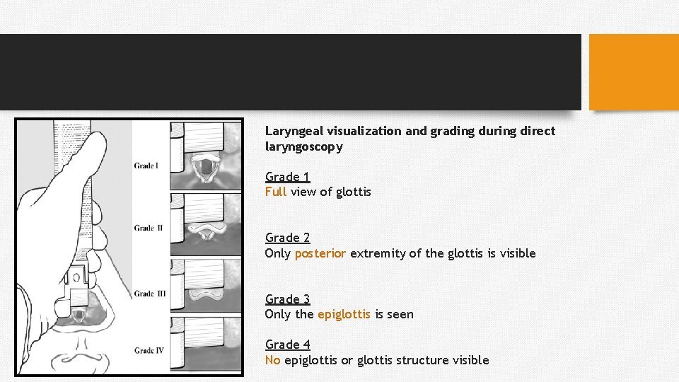 Laryngeal visualization and grading during direct laryngoscopy Grade 1 Full view of glottis Grade