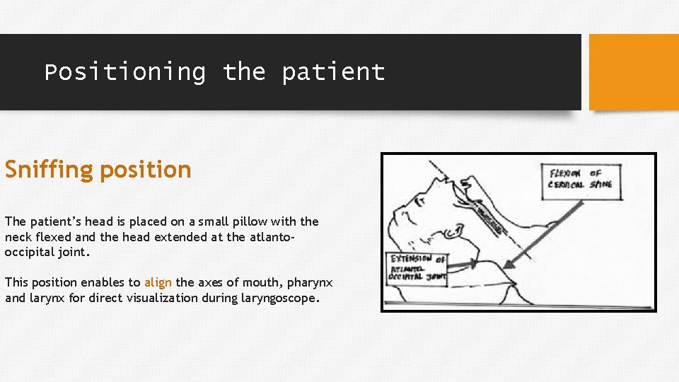 Positioning the patient Sniffing position The patient’s head is placed on a small pillow