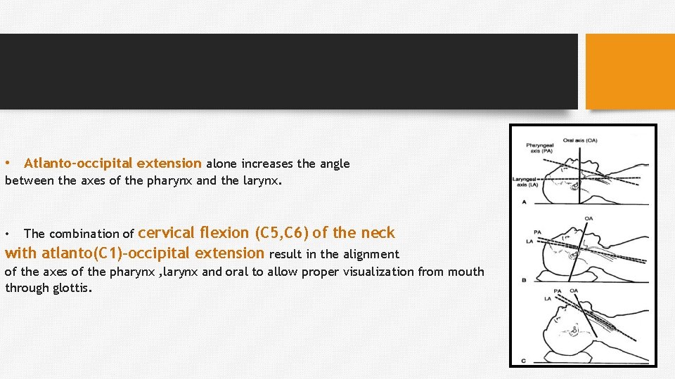  • Atlanto-occipital extension alone increases the angle between the axes of the pharynx