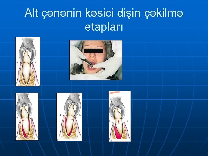 Alt çənənin kəsici dişin çəkilmə etapları 