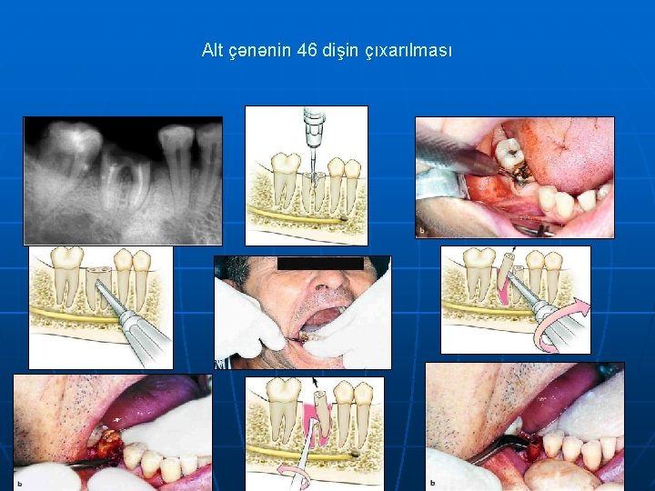 Alt çənənin 46 dişin çıxarılması 
