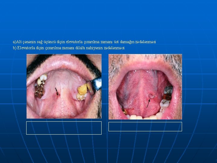 a)Alt çənənin sağ üçüncü dişin elevatorla çıxarılma zamanı üst damağın zədələnməsi b) Elevatorla dişin