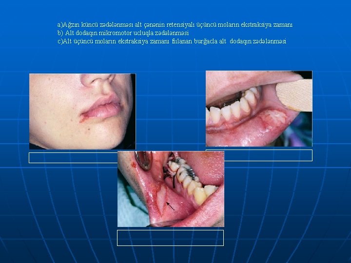 a)Ağzın küncü zədələnməsı alt çənənin retensiyalı üçüncü moların ekstraksiya zamanı b) Alt dodaqın mikromotor