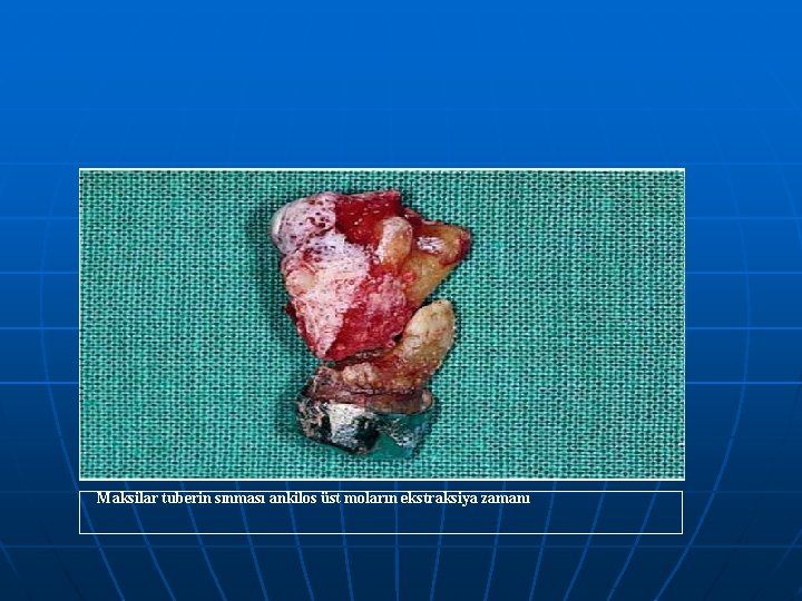 Maksilar tuberin sınması ankilos üst moların ekstraksiya zamanı 