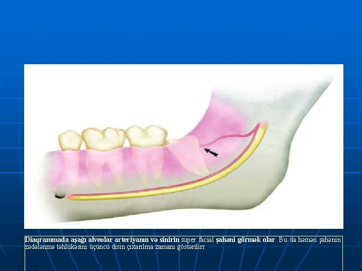 Diaqrammada aşağı alveolar arteriyanın və sinirin super facial şahəni görmək olar. Bu da həmən