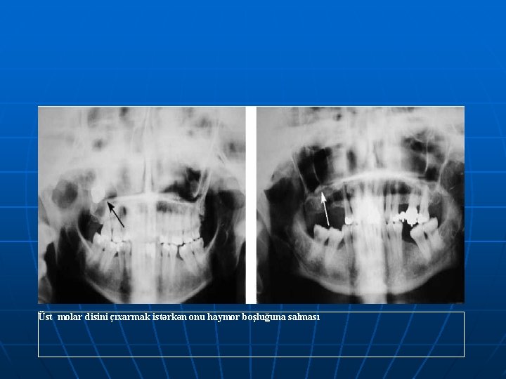 Üst molar disini çıxarmak istərkən onu haymor boşluğuna salması 