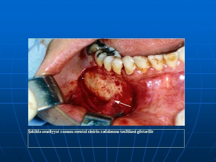 Şəkildə əməliyyat zamanı mental sinirin zədələnmə təxlükəsi göstərilir 