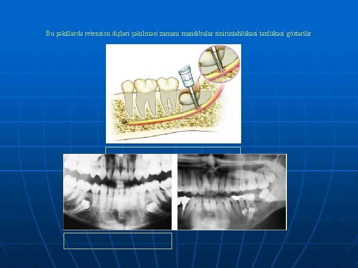 Bu şəkillərdə retension dişləri çəkilməsi zamanı mandibular sinirintəhlükəsi təxlükəsi göstərilir 