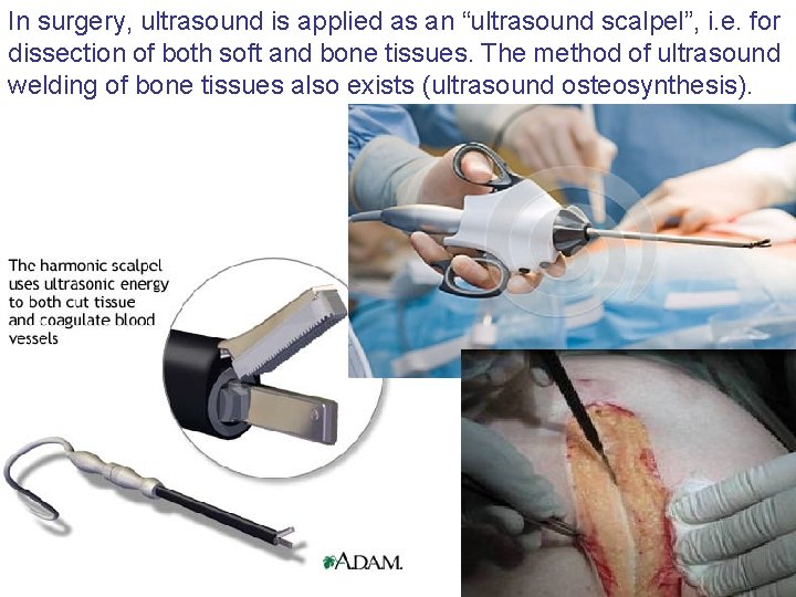 In surgery, ultrasound is applied as an “ultrasound scalpel”, i. e. for dissection of