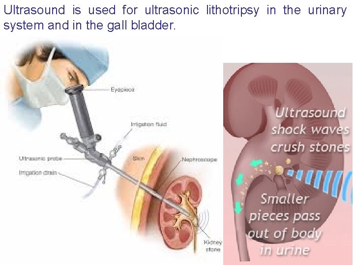 Ultrasound is used for ultrasonic lithotripsy in the urinary system and in the gall