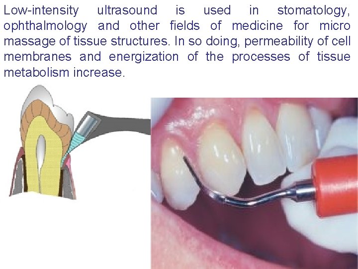 Low-intensity ultrasound is used in stomatology, ophthalmology and other fields of medicine for micro