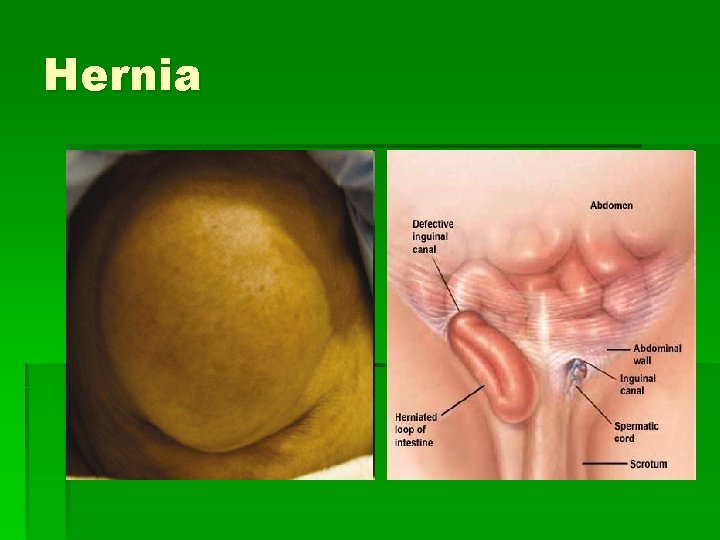 Hernia 
